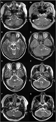 Clinical Characteristics and Outcomes of Multiple Sclerosis and Neuromyelitis Optica Spectrum Disorder With Brainstem Lesions as Heralding Prodrome